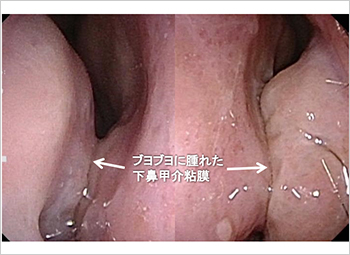 【図3】好酸球性副鼻腔炎の鼻内所見