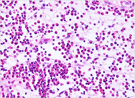 【図5】好酸球（ピンク色の丸い好酸球細胞を多数見止める）
