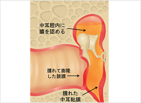 【図4】急性中耳炎のイラスト