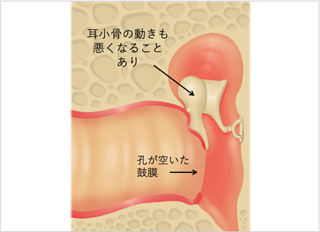 【図11】慢性中耳炎のイラスト