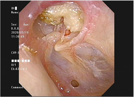 【図16】左真珠腫性中耳炎の鼓膜所見