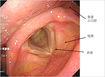【図3】喉頭の内視鏡画像