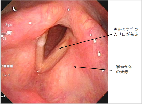 【図4】急性喉頭炎