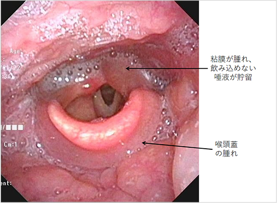 【図5】急性喉頭蓋炎