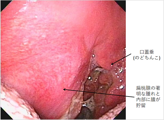 【図7】扁桃周囲炎・扁桃周囲膿瘍