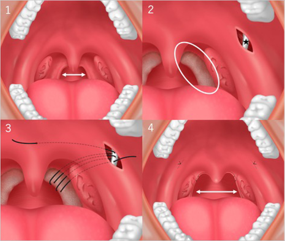 【図7】いびき対する咽頭（のど）の形成手術