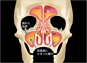 【図4】腫れた粘膜と膿汁の副鼻腔イラスト