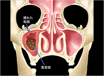 【図7】真菌塊が認められる副鼻腔のイラスト