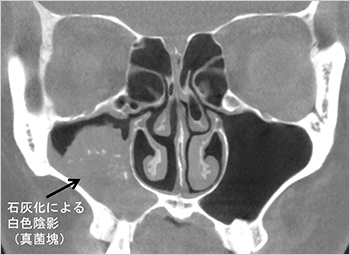 【図8】石灰化が認められる副鼻腔CT画像