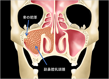 【図14】乳頭腫が認められる副鼻腔のイラスト