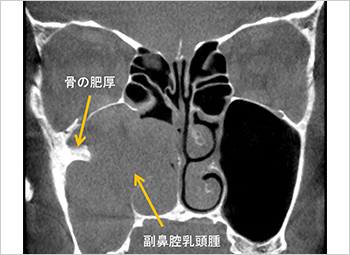 【図15】乳頭腫が認められる副鼻腔CT画像