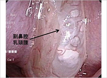 【図16】乳頭腫が認められる副鼻腔の内視鏡画像