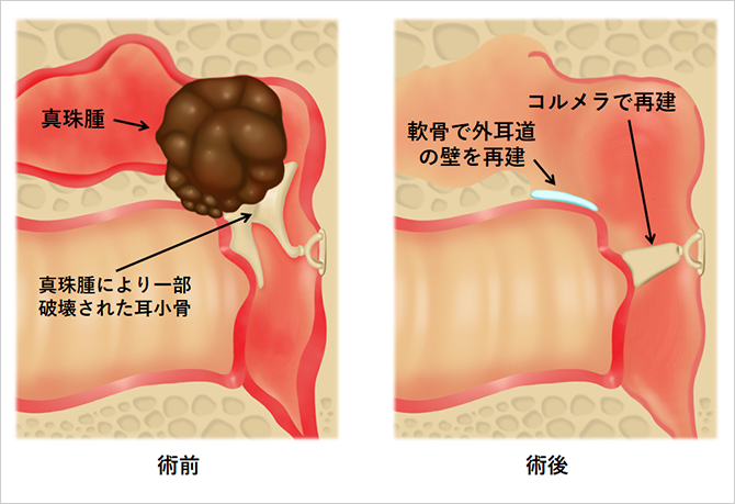 【図5】真珠腫性中耳炎の病変が軽い場合の手術方法