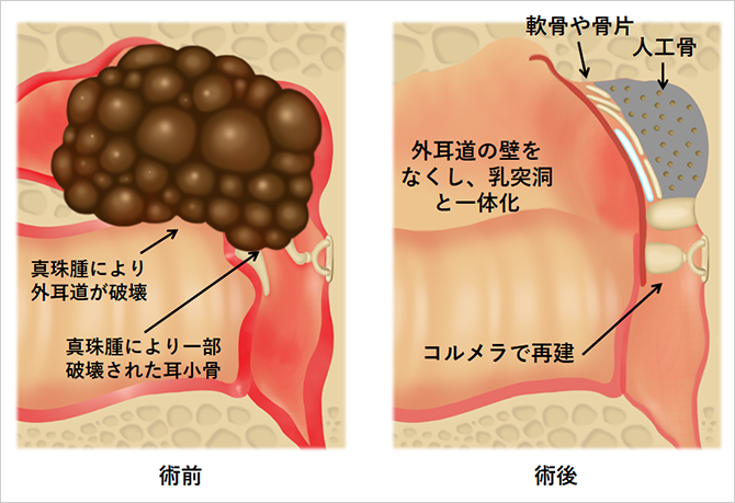 【図6】真珠腫性中耳炎の病変が奥まで進んでいる場合の手術方法