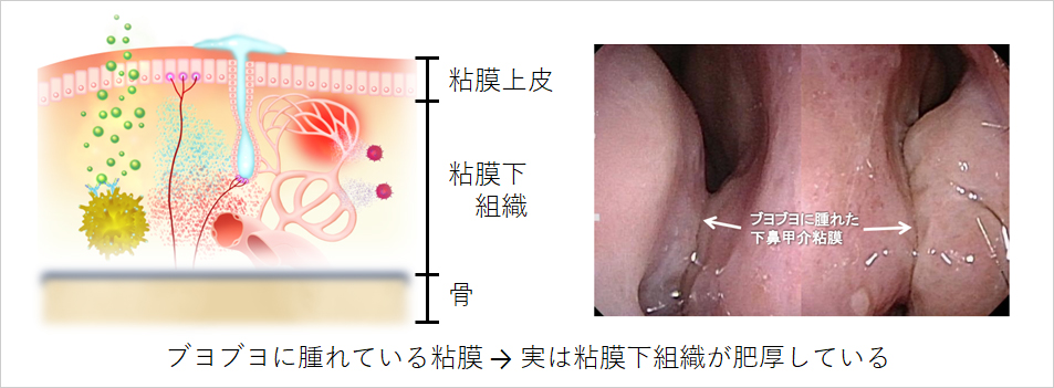 【図2】粘膜下組織の肥厚