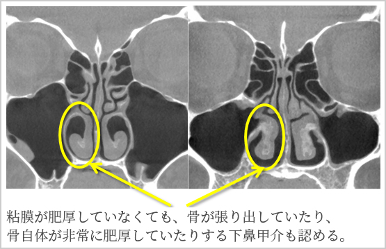 【図3】粘膜肥厚が原因ではない鼻づまり