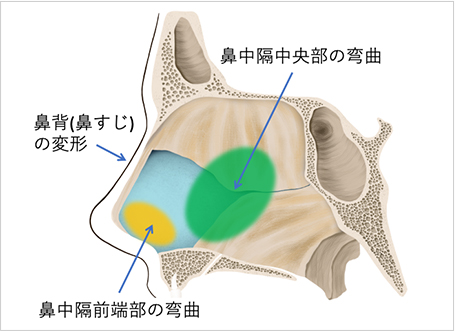 【図2】鼻中隔弯曲の種類