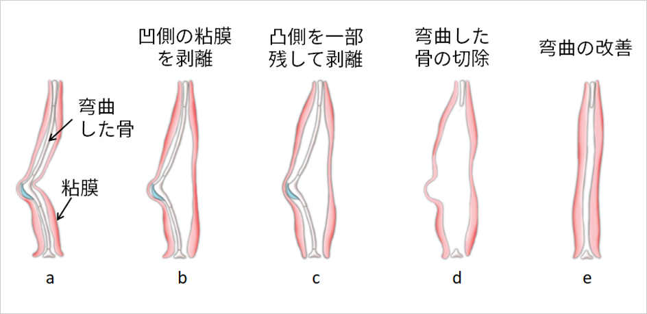 【図4】鼻中隔矯正術手術の流れ