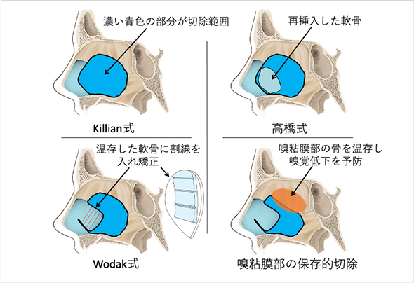 【図6】鼻中隔矯正術の手術方式の変遷