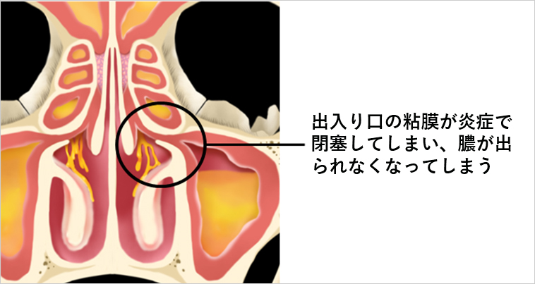 【図2】副鼻腔内の炎症